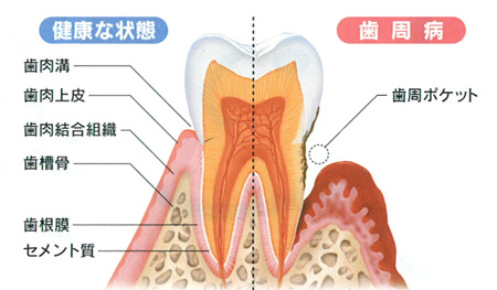 ひかりのテラス歯科クリニック_歯周病治療